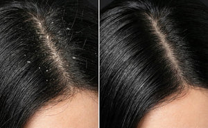 Shampoo Anticaspa y Purificante con Carbón Activado