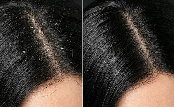Shampoo Anticaspa y Purificante con Carbón Activado